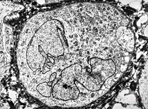 M,58y. | carcinoma gl. parotis M,58y. | carcinoma gl. parotis